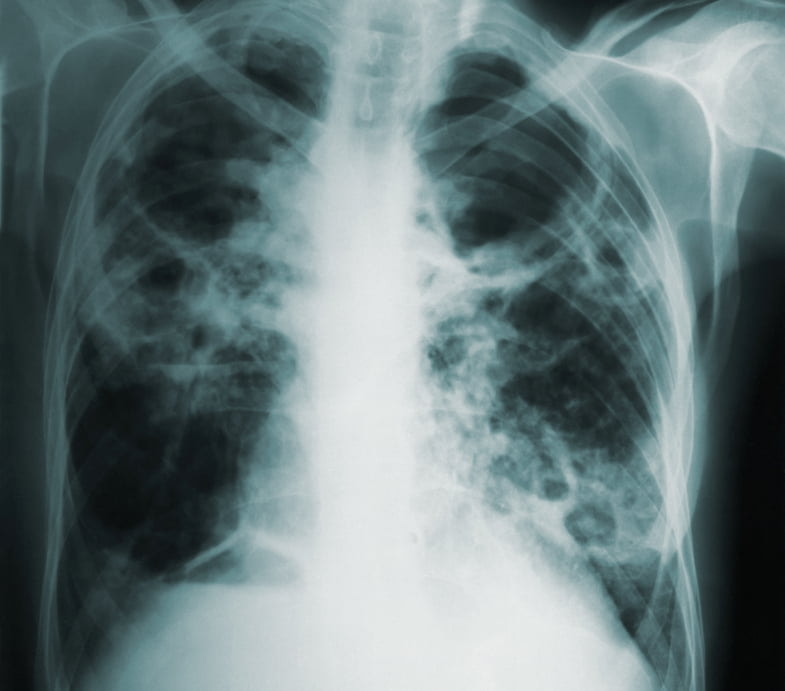 Placa que muestra los daños pulmonares causados por el tabaquismo